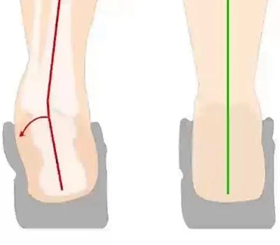 הערכת היפוך עקב והיפוך עקב: הערכה קלינית, יישומים מעשיים ושילוב מסחרי