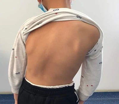 סקר וניהול עקמת: כיצד Xianku 3D Body Scanner מסייע לכירופרקטורים