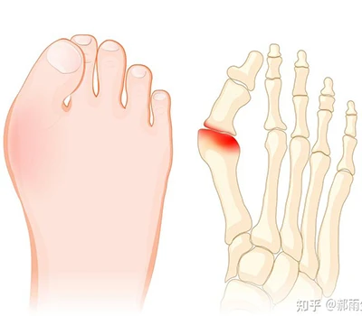 Hallux Valgus: מדריך מדע שלם