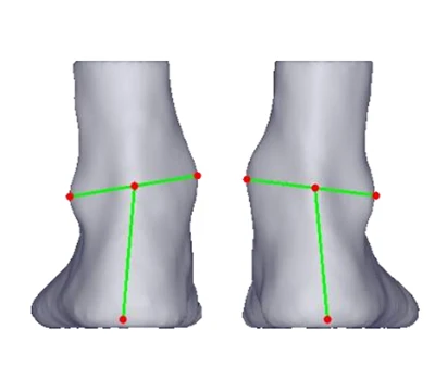 עקב valgus ו- varus: איום שקט על פני