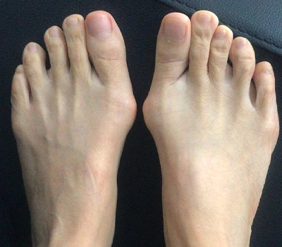 מדידת Valgus של Hallux: מדוע סורקי תלת מימד עולים על קלינאים ובתי חולים